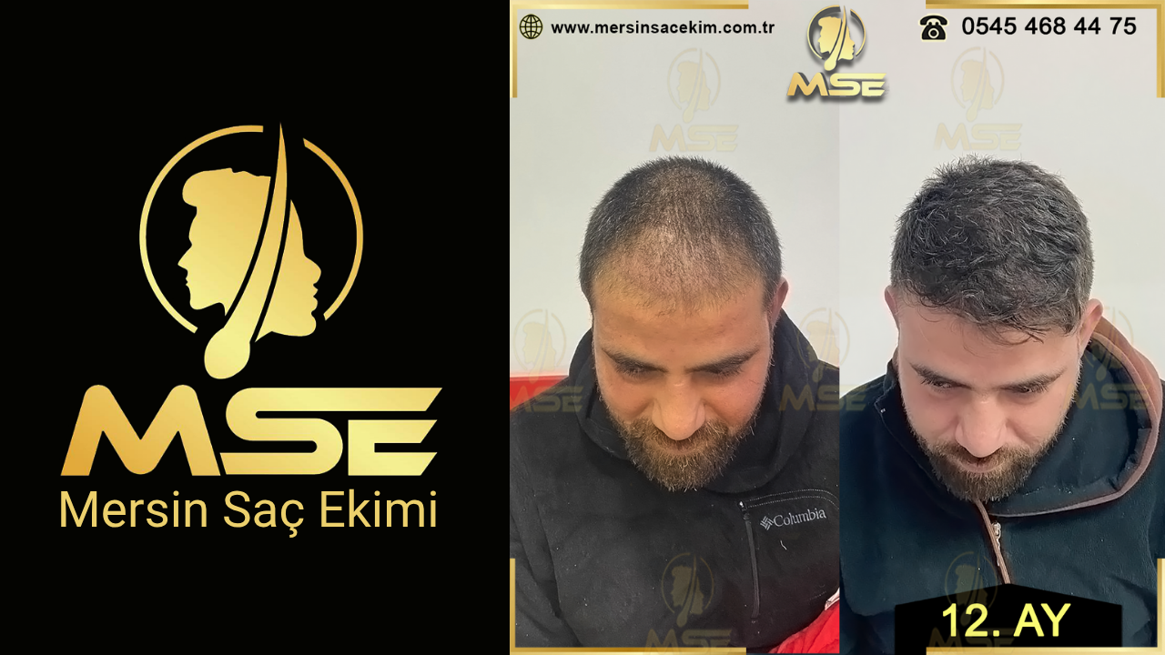 MERSİN SAÇ EKİMİ